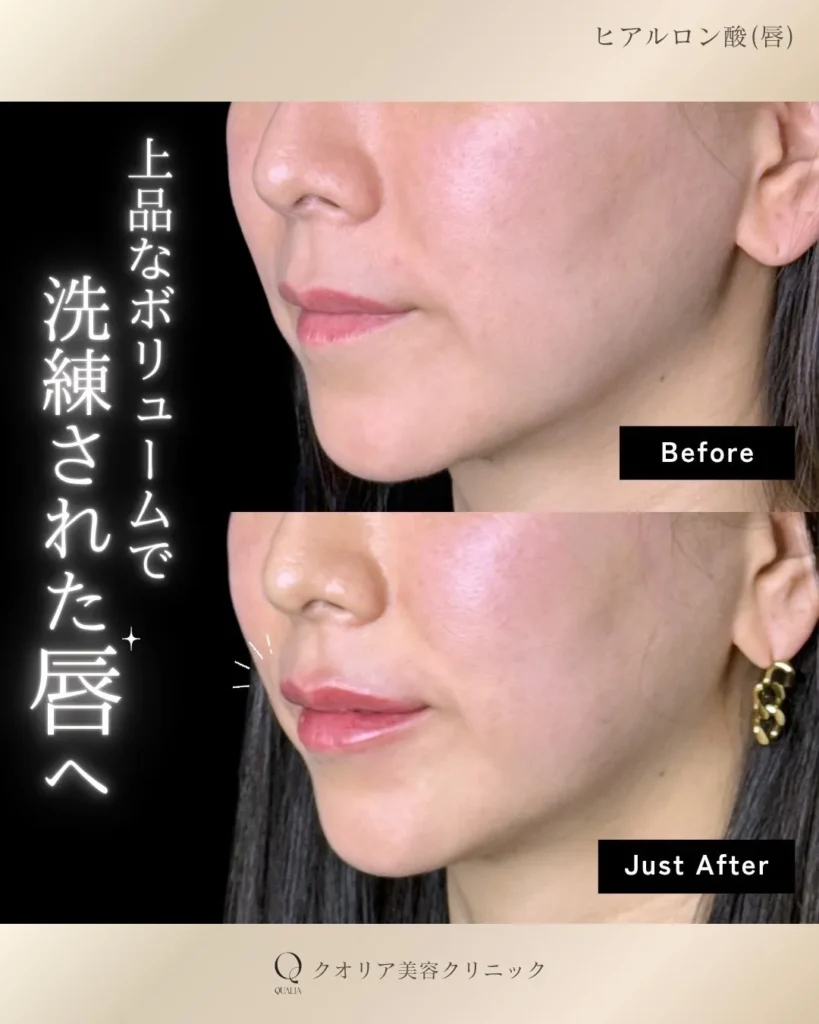 ヒアルロン酸注入(唇)の症例写真