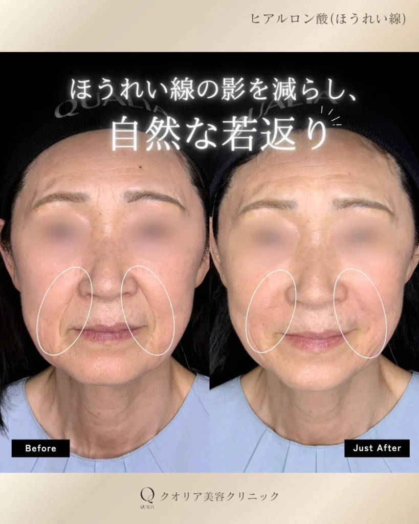 ヒアルロン酸注入(ほうれい線)の症例写真